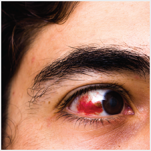 Eye Injuries-01